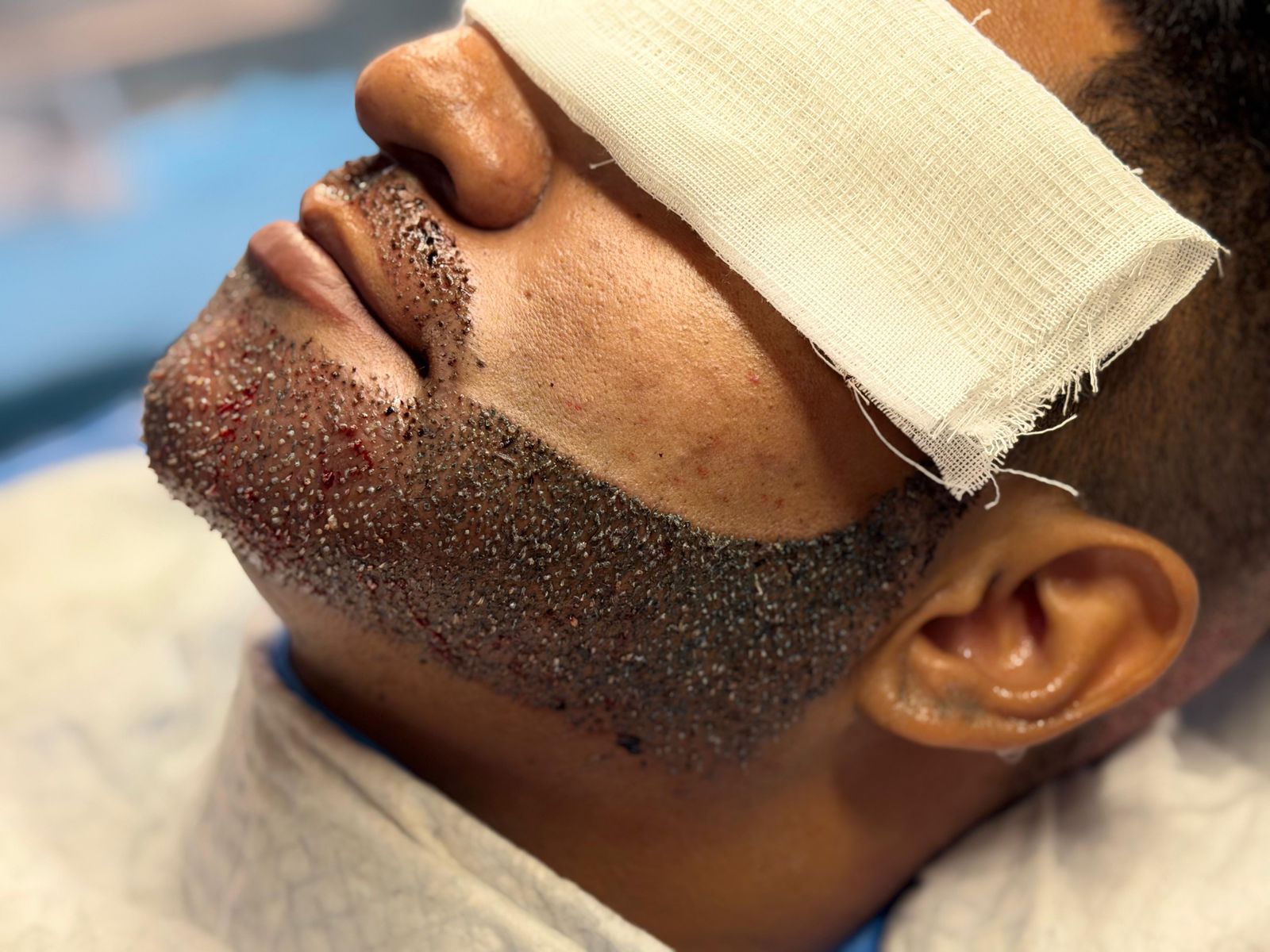 Transplante de Barba