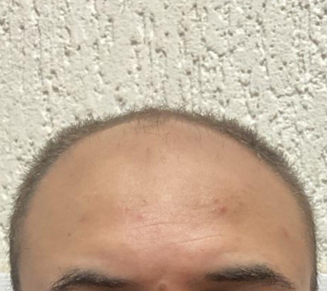 Antes do transplante capilar