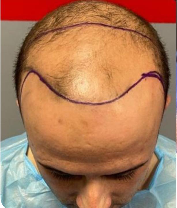 Antes do transplante capilar