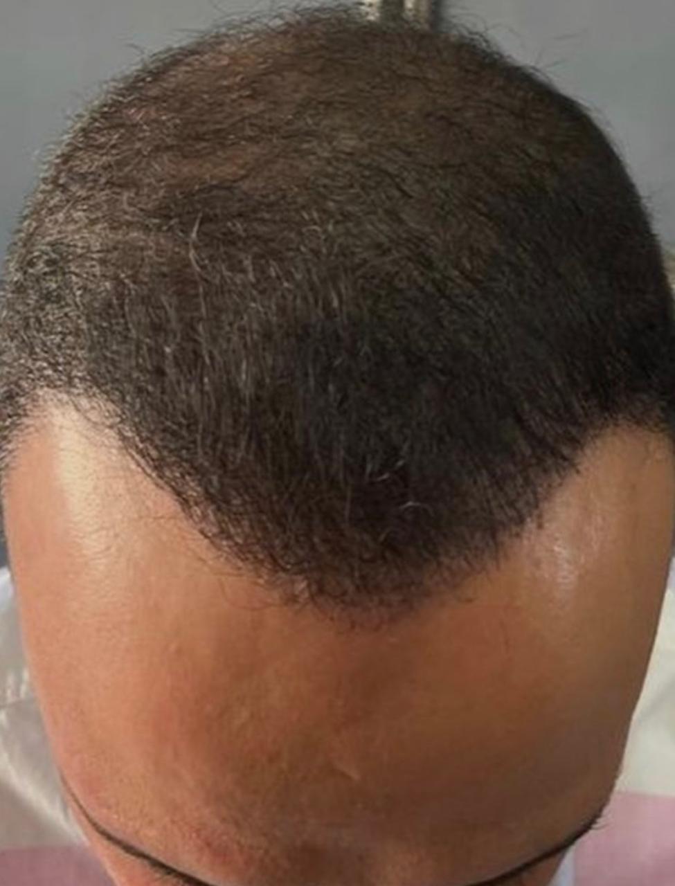 Depois do transplante capilar