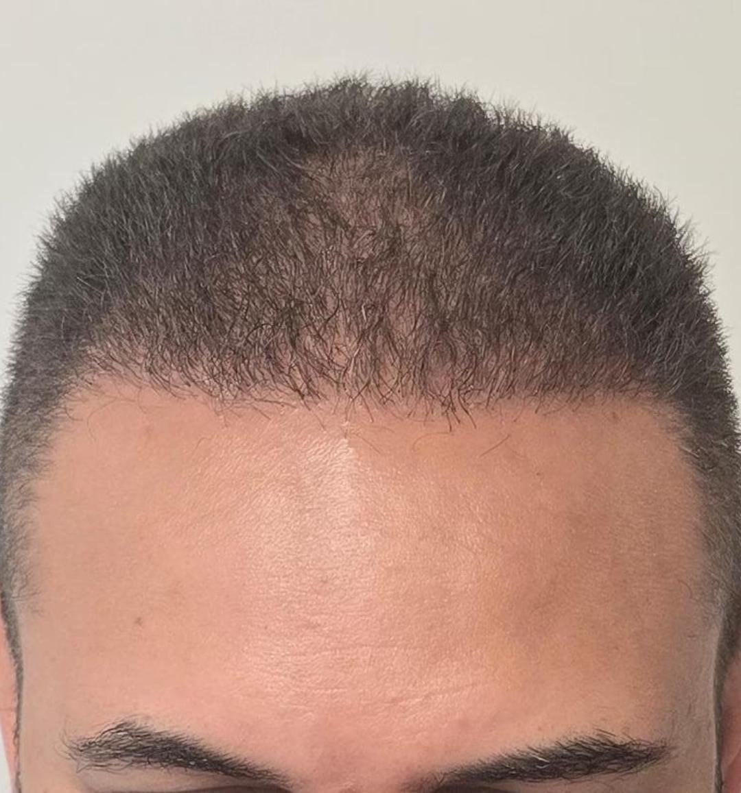 Depois do transplante capilar